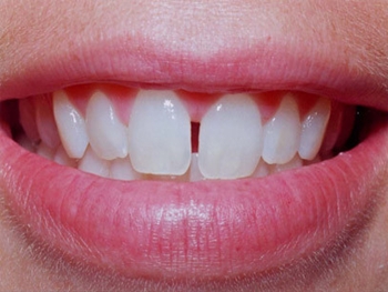Espaços entre os dentes pode ser sinônimo de problemas na saúde bucal